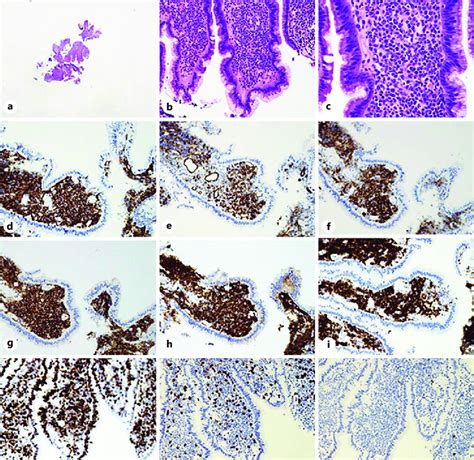 Biopsy Of The Duodenal Ulcer Demonstrates Duodenal Mucosa With