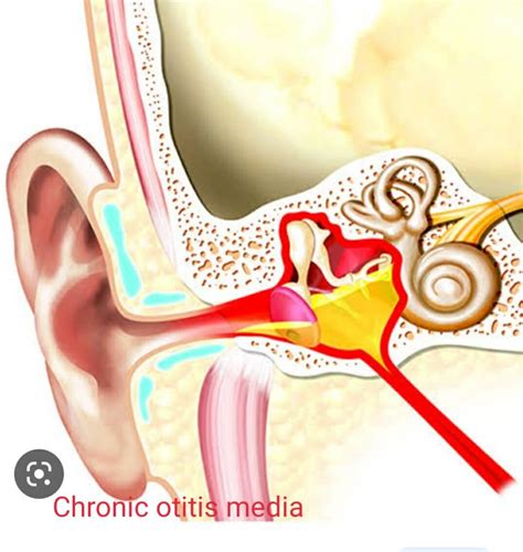 Chronic Otitis Media