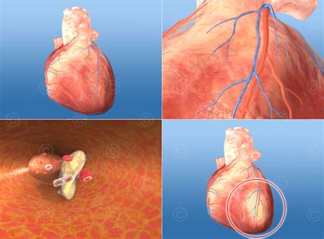 Myocardial Infarction Animation