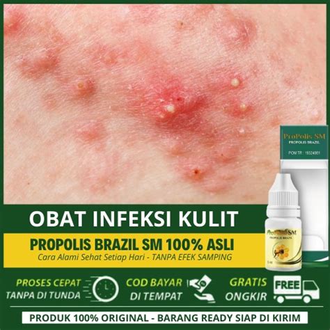 Jual Obat Infeksi Kulit Karena Bakteri Jamur Pada Anak Di Wajahandkepala