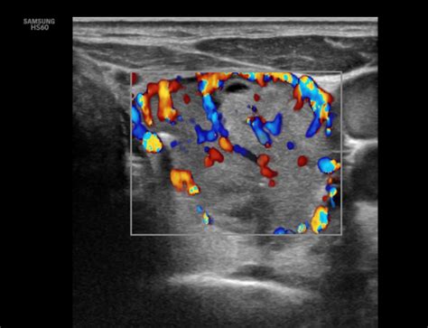 Limpatto Della Ecografia Nella Diagnosi Dei Noduli Tiroidei Tiroide Org