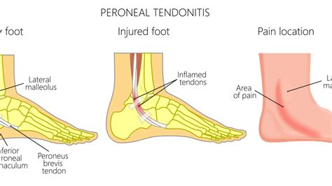 Tendonitis Of The Foot Renew Physical Therapy