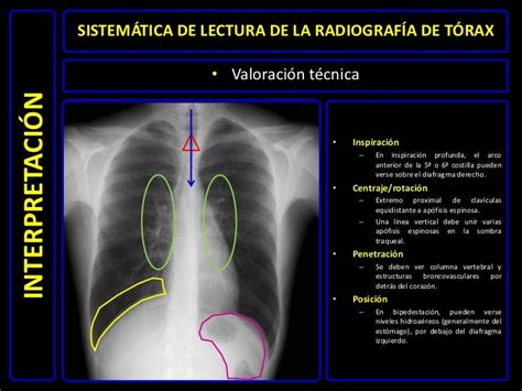 Diagnóstico Por Imágenes Radiografía De Tórax Normal