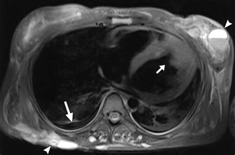 Cardiac Metastases From Melanoma Radiographics