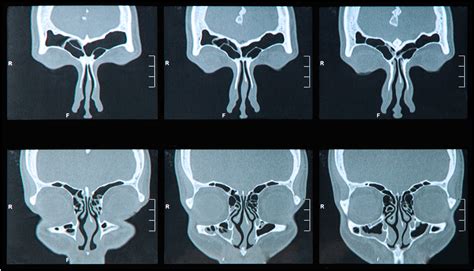 Biologics For Chronic Rhinosinusitis With Nasal Polyps Guide