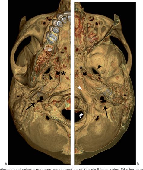 Figure 1 From Differential Diagnosis Of Jugular Foramen Lesions