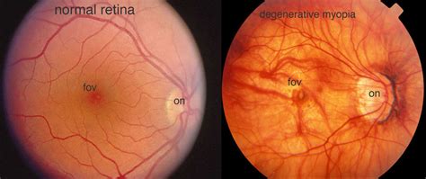 A Fundus Photograph Of The Retina Of A Person With Degenerative Myopia