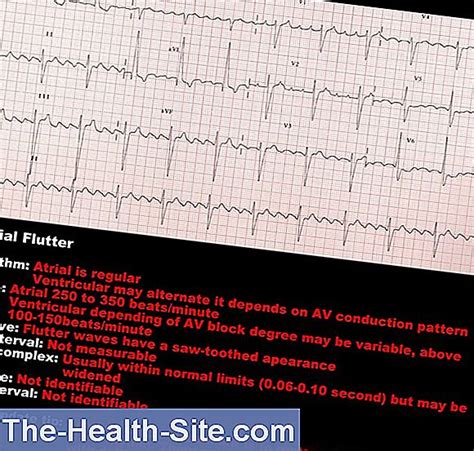 Atrial Flutter Causes And Treatment 💊 Scientific Practical Medical Journal 2023