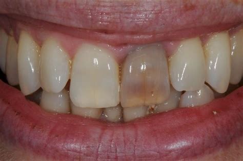 Services Dark And Discoloured Single Teeth Brisbane Prosthodontics