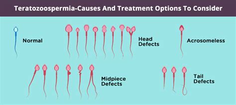 Teratozoospermia-Causes And Treatment Options To Consider | Aveya IVF