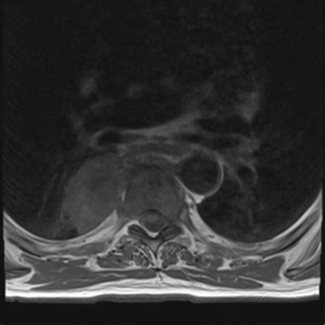 Thoracic Paravertebral Abscess And Osteomyelitis Image Radiopaedia Org