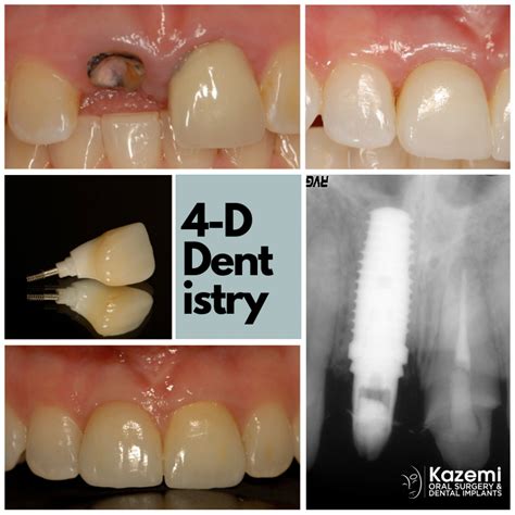 Implants for Front Teeth ( Smile Zone) | Implants for Front Teeth ( Smile Zone) - Kazemi Oral ...