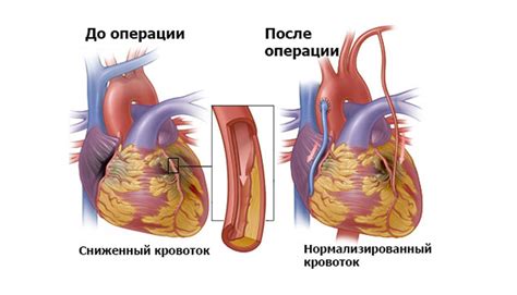 АОРТОКОРОНАРНЕ ШУНТУВАННЯ – ДНУ «НПЦ ПКМ» ДУС