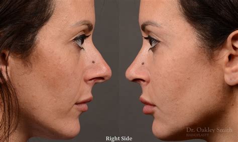 Rhinoplasty Before And After Case 495 Toronto Rhinoplasty Surgery