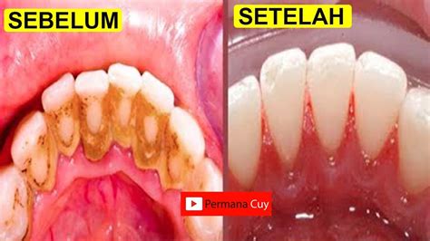 Cara Nak Untuk Hilangkan Karang Gigi AkiraknoePerry