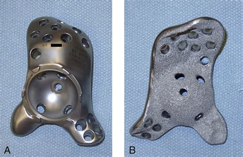 Triflange Acetabular Components For Complex Revision Cases