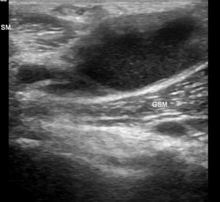 Baker Cyst Radiology Reference Article Radiopaedia Org