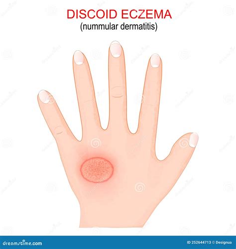 Nummular Dermatitis. Discoid Eczema Stock Vector - Illustration of health, atopic: 252644713