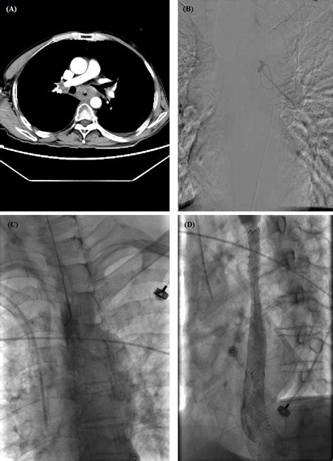 Frontiers Compression Hemostasis Using Fully Covered Self Expandable