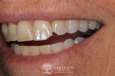 Restore Fractured Teeth From Accident Lakeview Dental