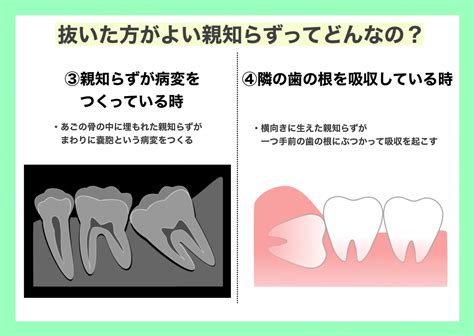 親知らずの抜歯について｜中村歯科医院のブログ