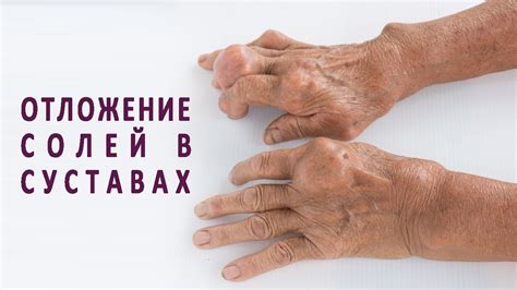 Отложение солей в суставах: основные симптомы и лечение