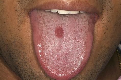 Median Rhomboid Glossitis Cancer Wolfbowpaintingsorder