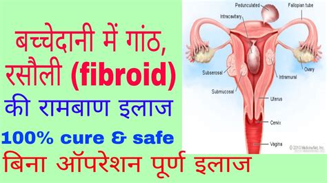 How To Cure Uterine Fibroids बिना ऑपरेशन बच्चेदानी की फाइब्रॉइड हमेशा के लिया ठीक होता हैं