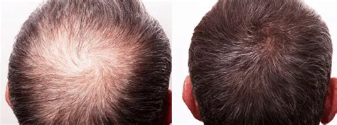 Does PRP Hair Treatment Really Work Hair Transplant Dubai