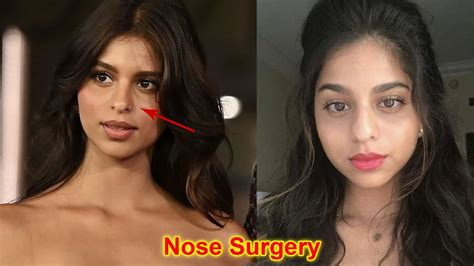 Shahrukh Khan Daughter Suhana Khan Nose And Face Surgery Before Her