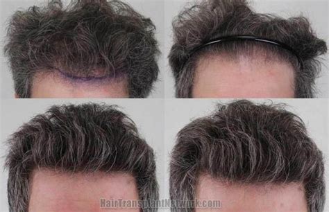 Dr H Rahal Hair Restoration Procedure Before And After Result