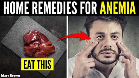 Anemia Symptoms Best Home Remedies For Anemia Youtube