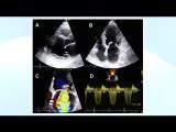 Evaluación ecocardiográfica de la cardiopatía reumática Vídeo