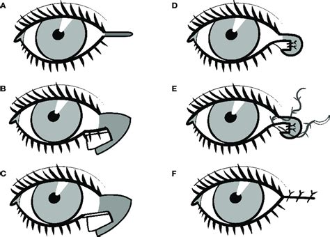 The Schematic Presentation Of The Lateral Tarsal Strip Technique A A