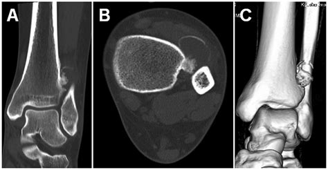 Periosteal Chondroma Of The Distal Tibia Computed Tomography And