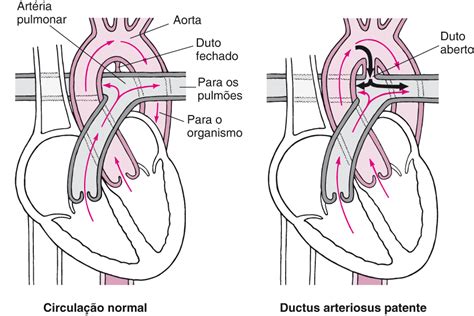 Tetralogia De Fallot O Que Diagn Stico E Tratamento