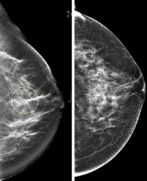 What Does Breast Cancer Look Like On An Ultrasound