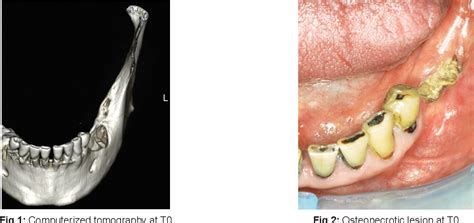 Figure 1 From Treatment Of Osteoradionecrosis Of The Jaw With Ozone In