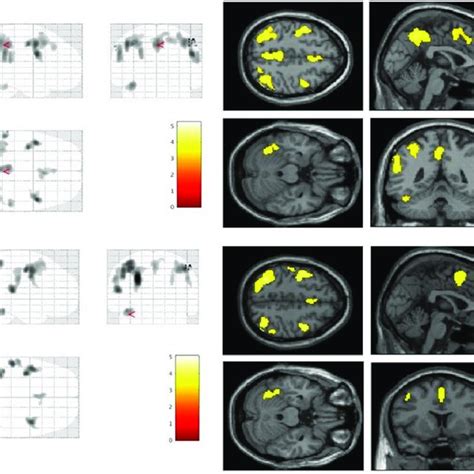 Areas Of Increased Regional Cerebral Blood Flow In Patients With Visual