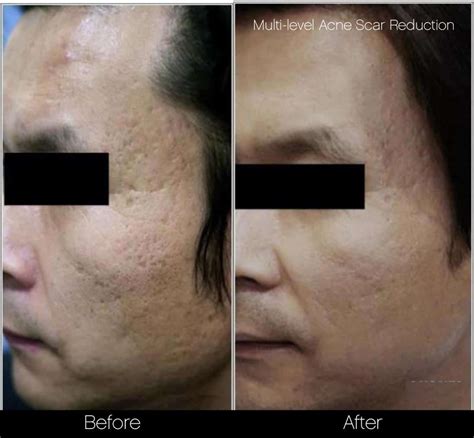 Acne Laser Scar Removal Before And After