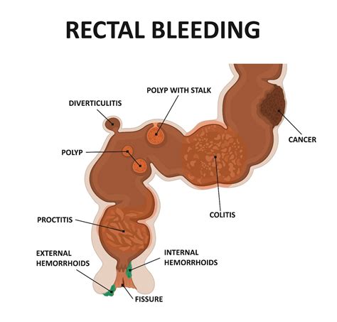 Hemorrhoids Bleeding Stool