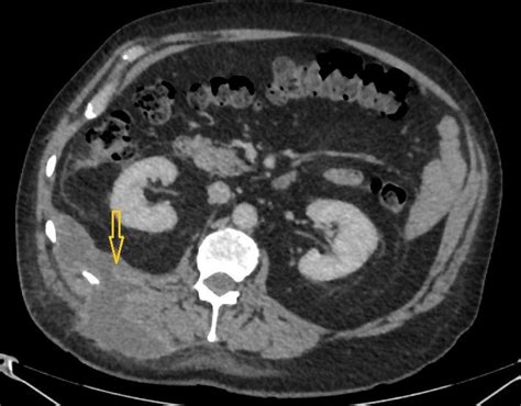 Ct Scan Abdomen Demonstrates A Retroperitoneal Abscess Tracking Through Download Scientific