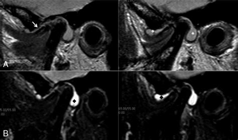 Magnetic Resonance Images Of The Right Temporomandibular Joint