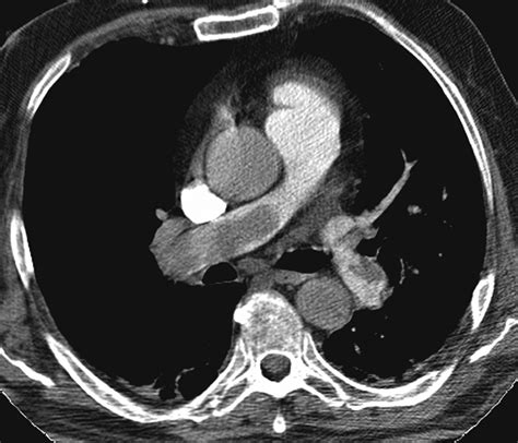 Six Cases Of Acute Central Pulmonary Embolism Revealed On Unenhanced Multidetector Ct Of The