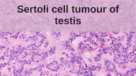 Sertoli Cell Tumour Of The Testis Pathology Mini Tutorial Youtube