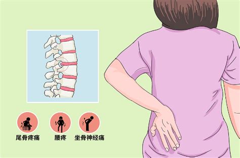 腰椎间盘突出保守治疗如何康复训练一 知乎