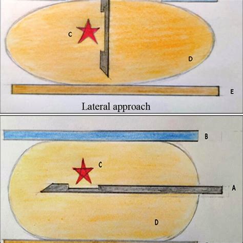 Schematic Diagram Showing Lateral And Vertical Approach A Biopsy Download Scientific Diagram