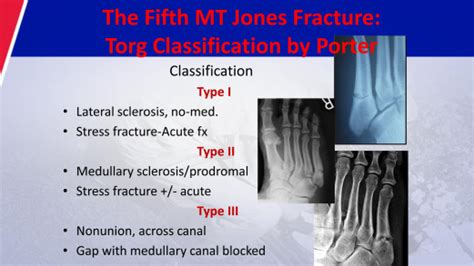 Which Is The Correct Definition Of A Stress Fracture Apex Nicole Has