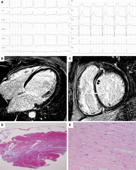 Arrhythmogenic Right Ventricular Cardiomyopathy Characterization Of