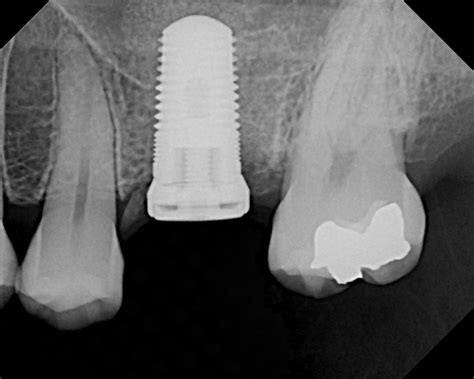 Dental Implant X-rays